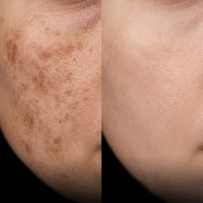 Melasma hormonal en pómulos y labio superior